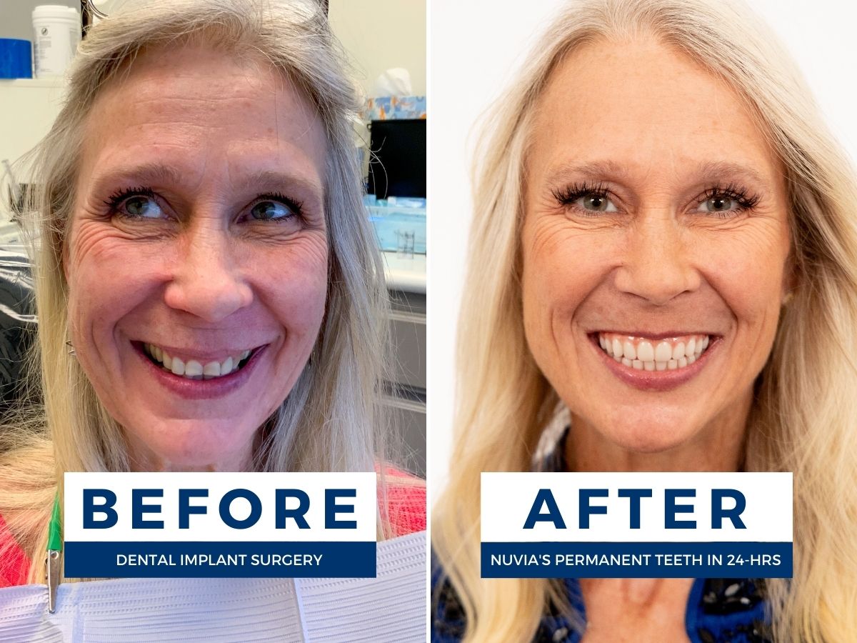 Leslie Before and After Dental Implants