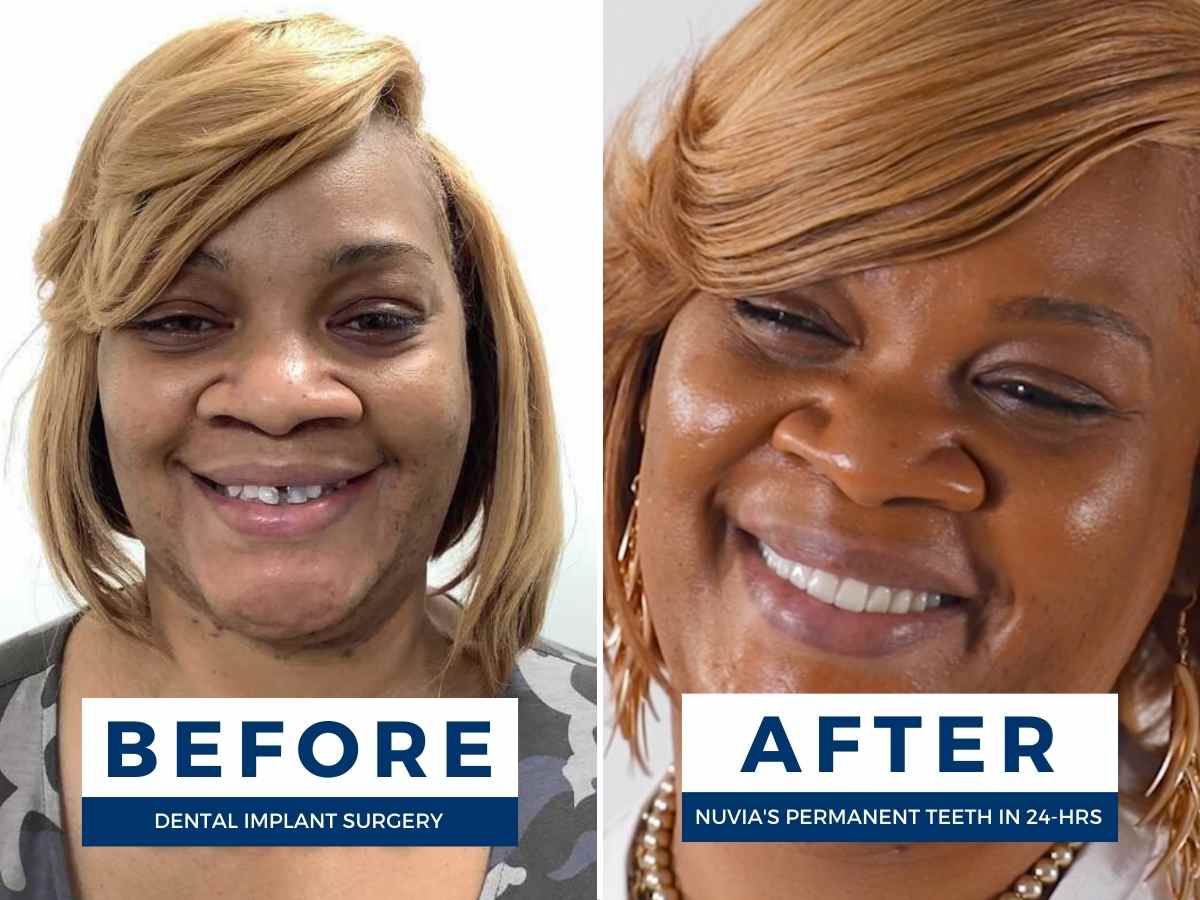Sharanna Before and After Dental Implants
