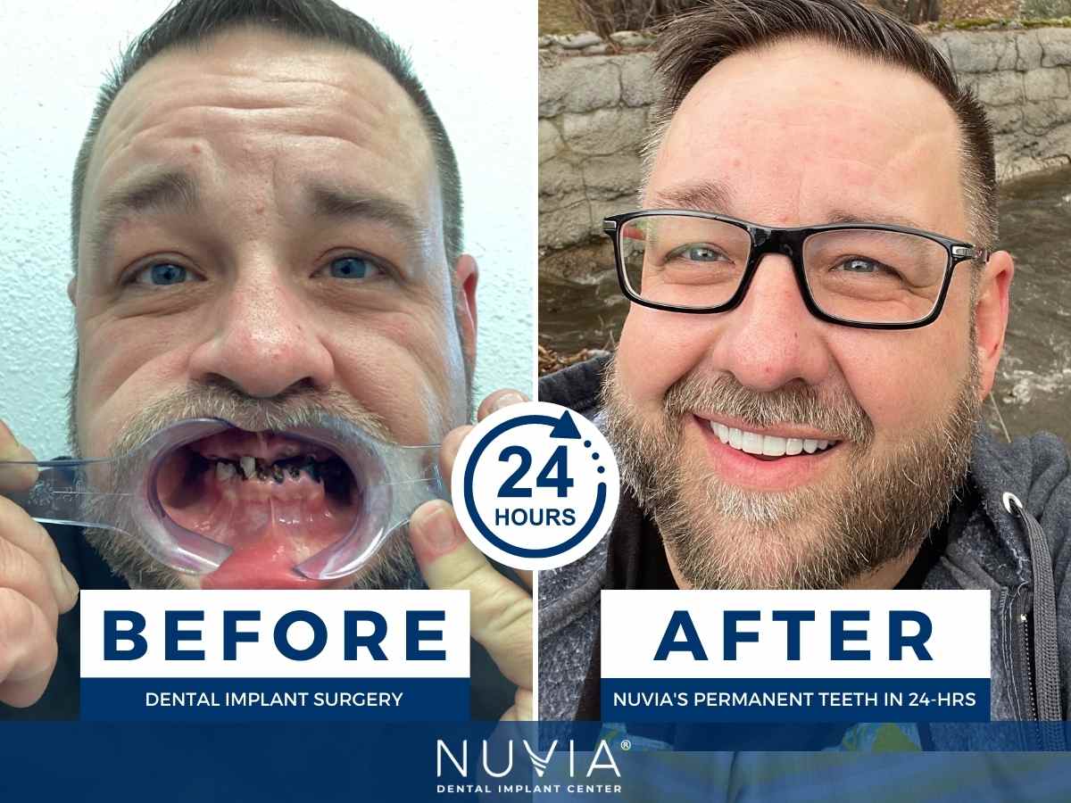 Shaun Before and After Dental Implants