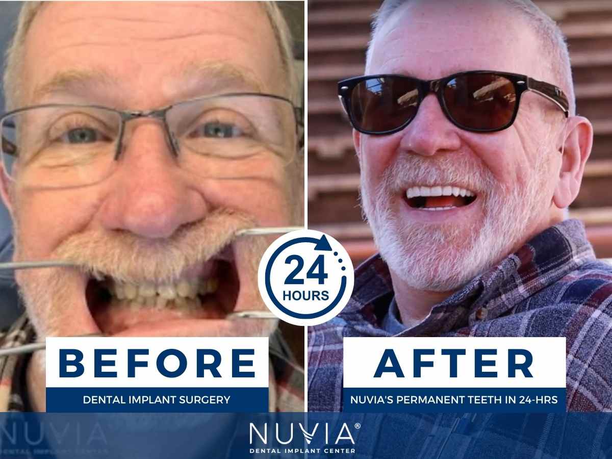 Duncan Before and After Dental Implants