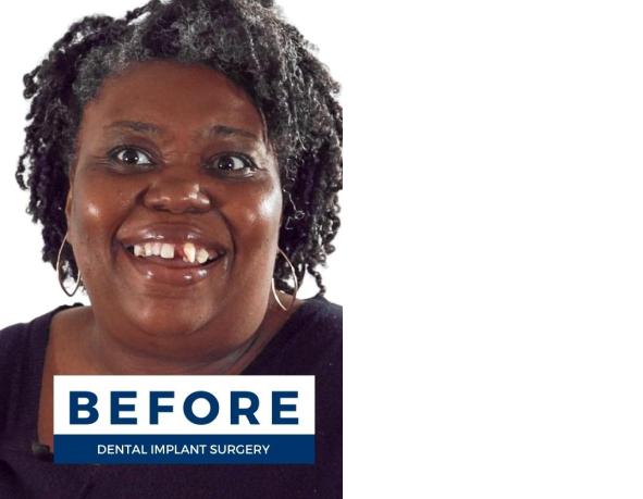 Sharala Before Dental Implants