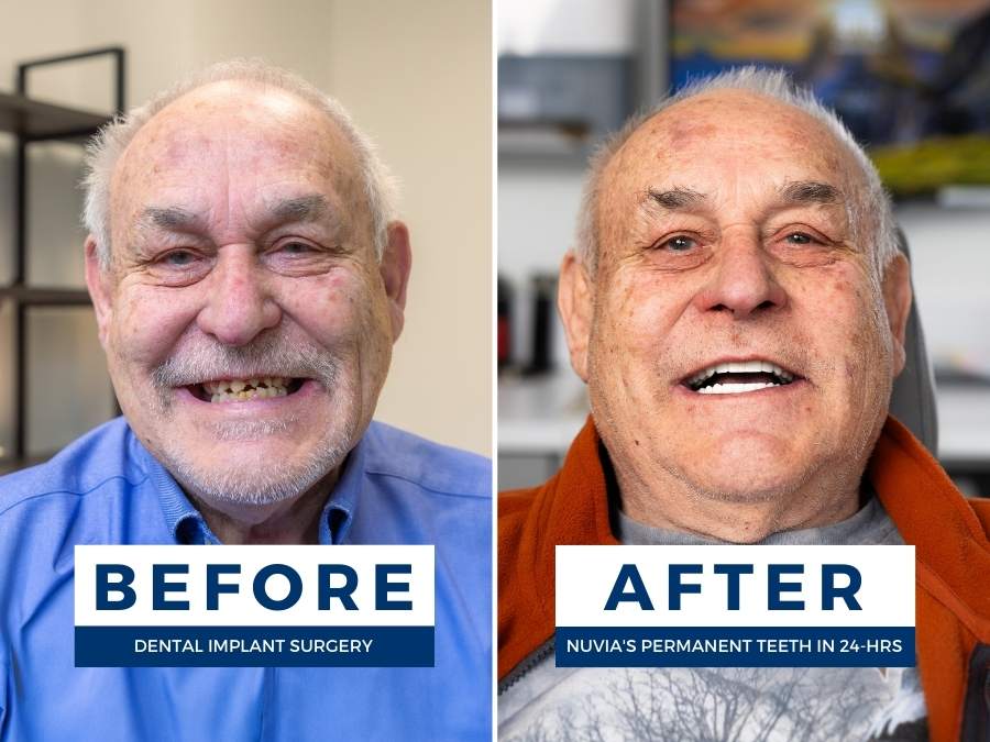 Man before and after dental implants