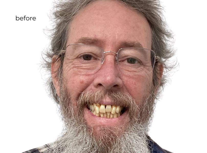 Before getting dental implants at nuvia