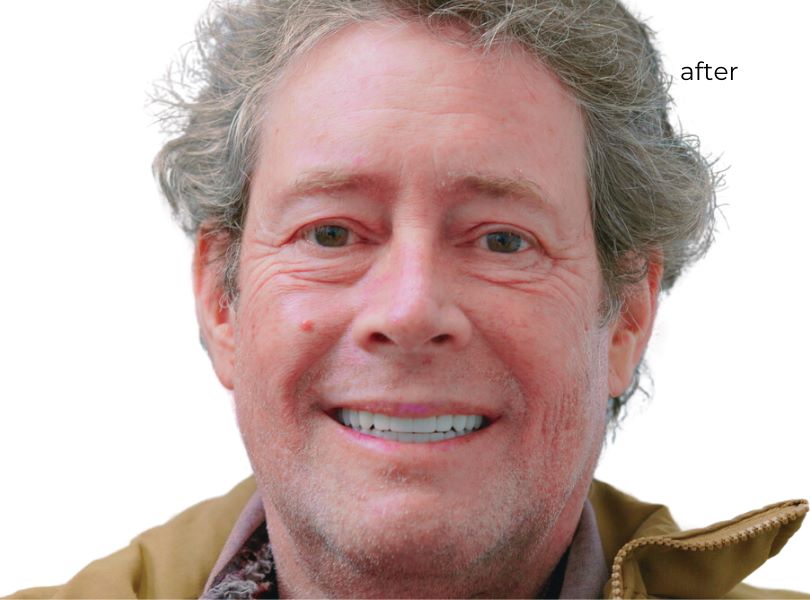 Dental implant center reviews patient after implants