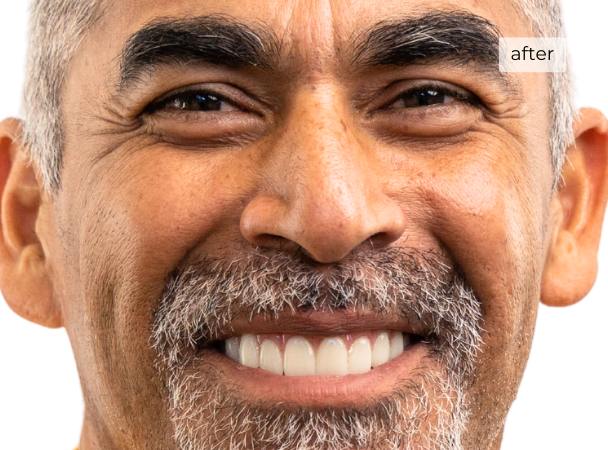 Man smiling after getting dental implants