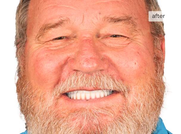 Man smiling after dental implants
