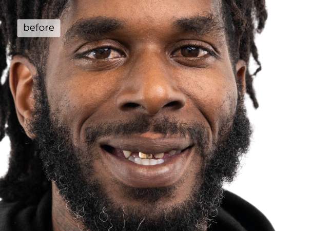 Man smiling after dental implants