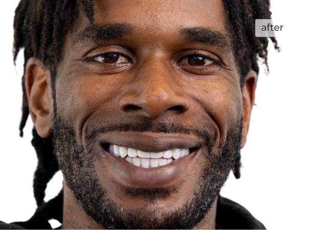 Man smiling after dental implants
