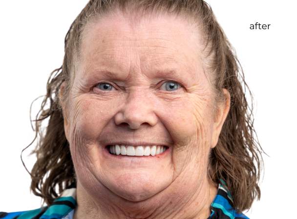 Nuvia Dental Implants