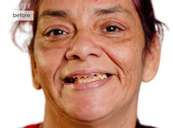 Woman smiling before getting dental implants