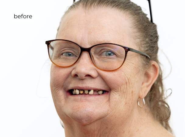 woman before getting dental implants