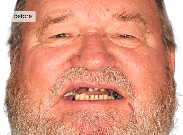 Man smiling before getting dental implants