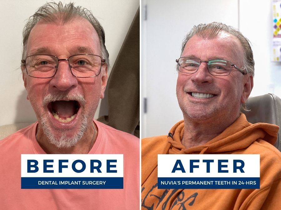 Man smiling before and after getting new teeth