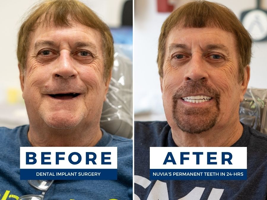Man smiling before and after getting new teeth