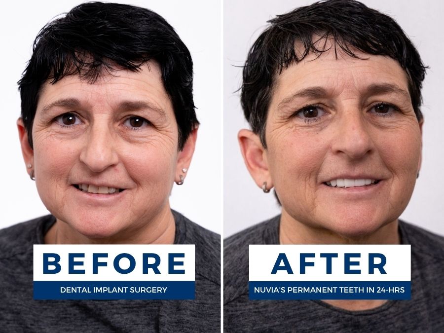 Woman smiling before and after getting new teeth