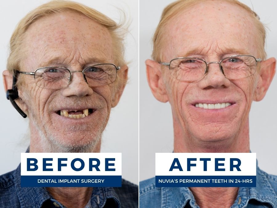 Man smiling before and after getting new teeth