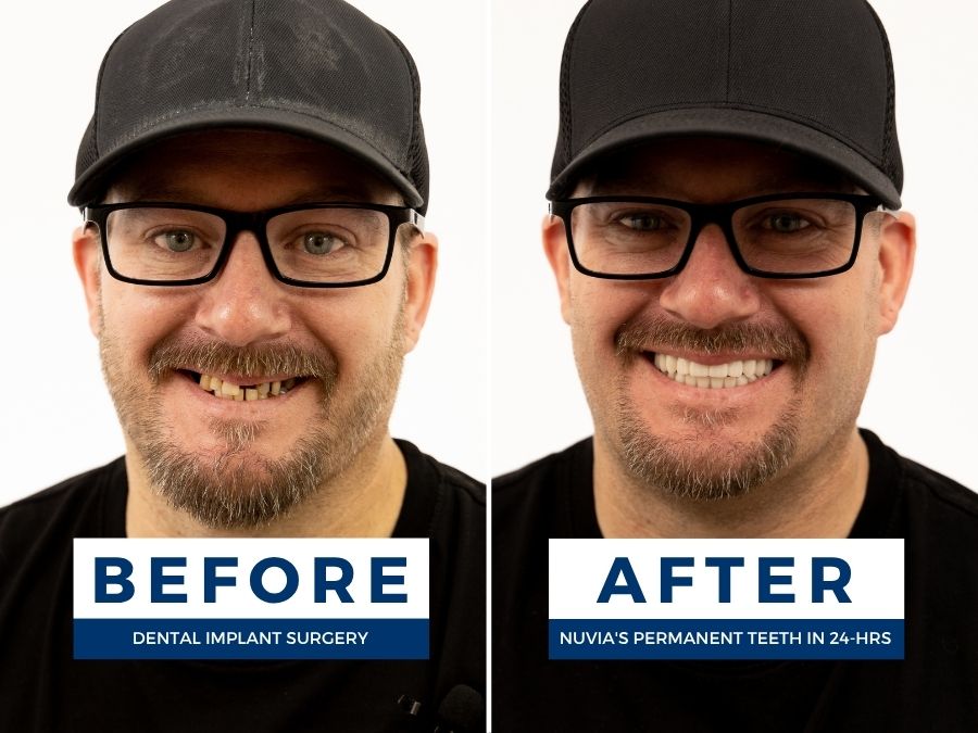 Man smiling before and after getting new teeth