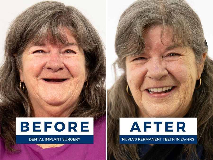Woman smiling before and after getting new teeth