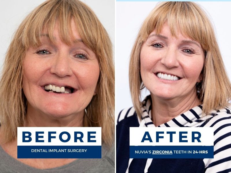 Two photos of a woman; one smiling before dental implants and one smiling after