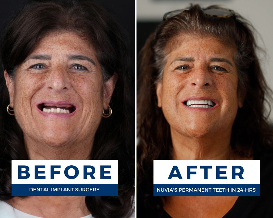 Woman smiling before and after replacing dentures with dental implants