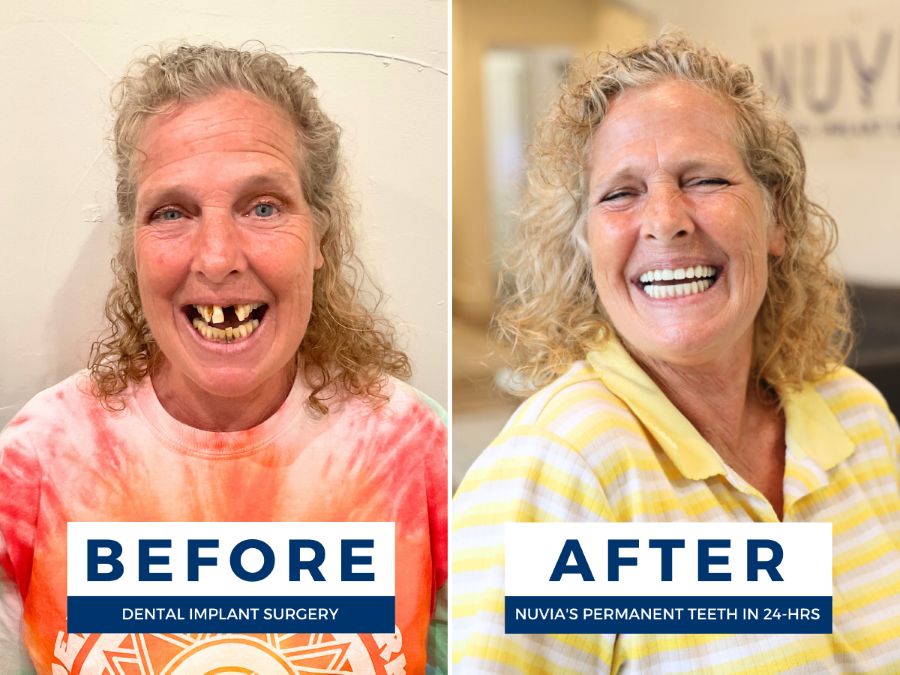 Two photos of a woman; one smiling before dental implants and one smiling after