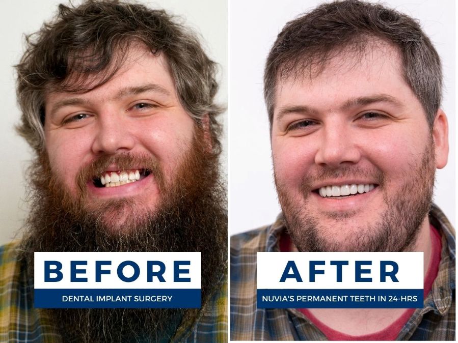 Two photos of a man; one smiling before dental implants and one smiling after