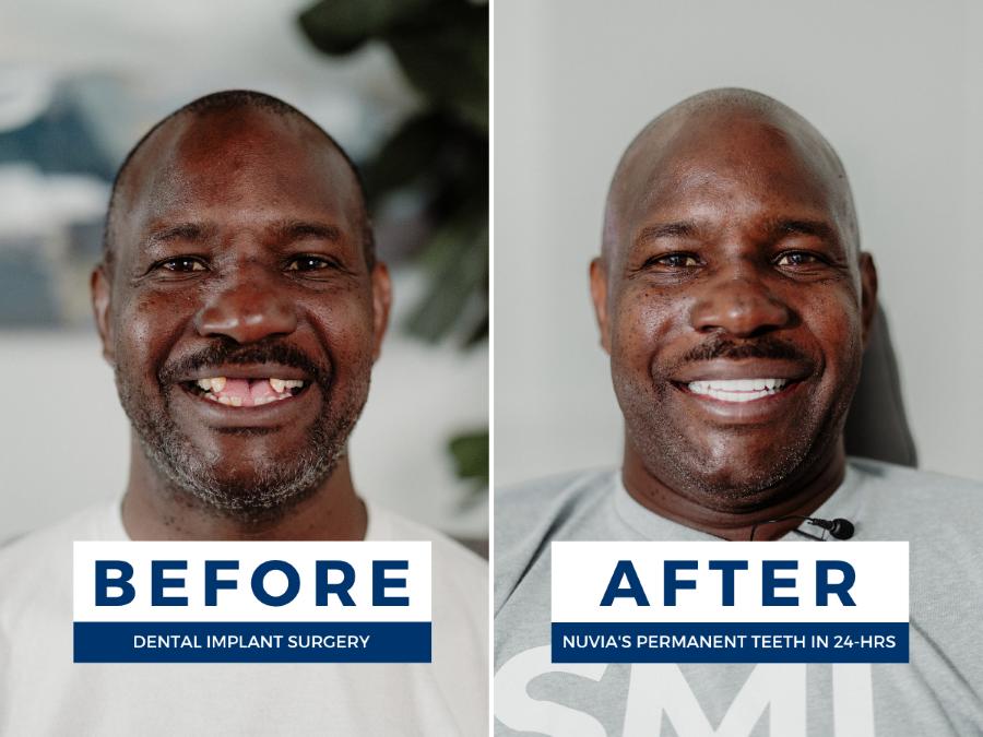 Two photos of a woman; one smiling before dental implants and one smiling after