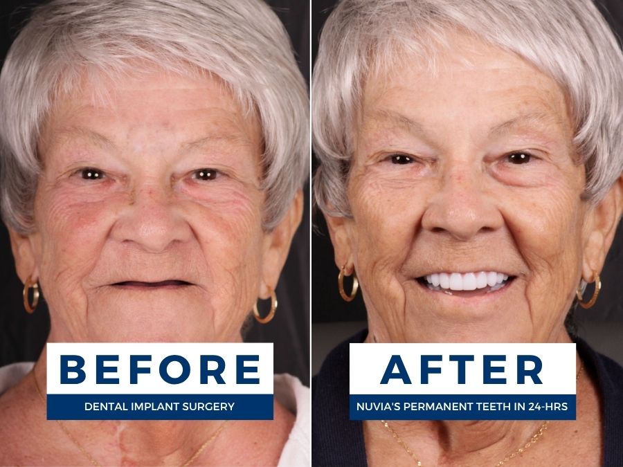 Woman smiling before and after having snap in dentures replaced by dental implants