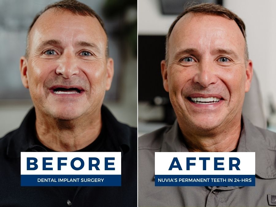 Man smiling before and after having snap in dentures replaced by dental implants