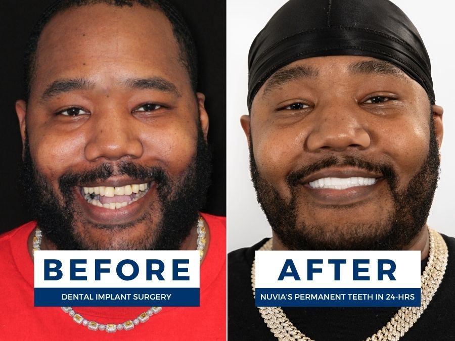 Man smiling before and after having snap in dentures replaced by dental implants