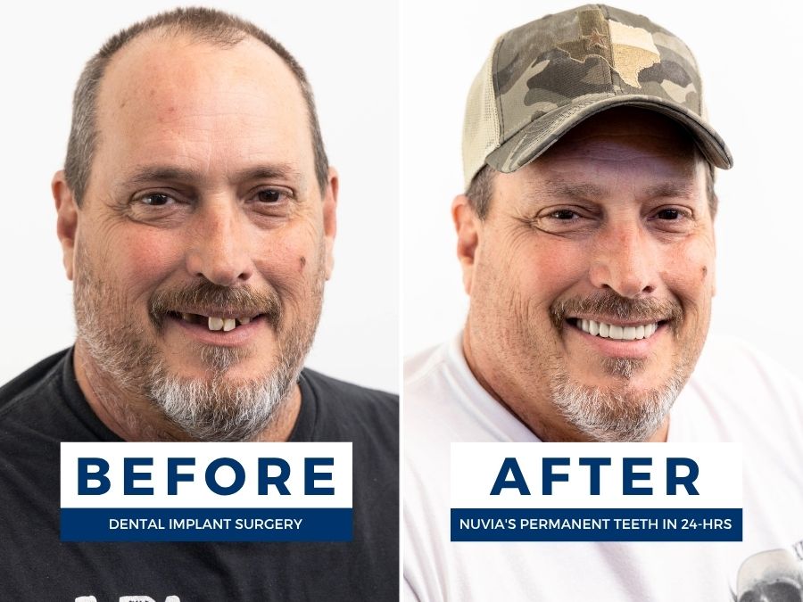 Man smiling before and after having snap in dentures replaced by dental implants
