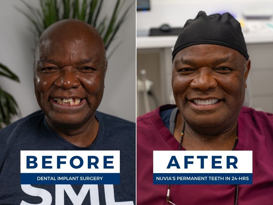 Man smiling before and after having snap in dentures replaced by dental implants