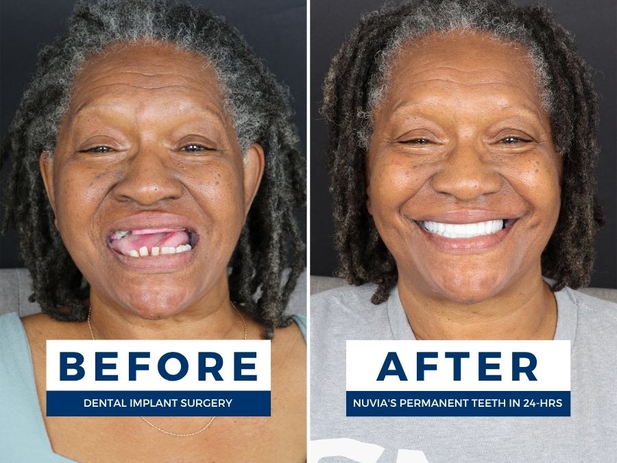 Woman smiling before and after replacing dentures with dental implants