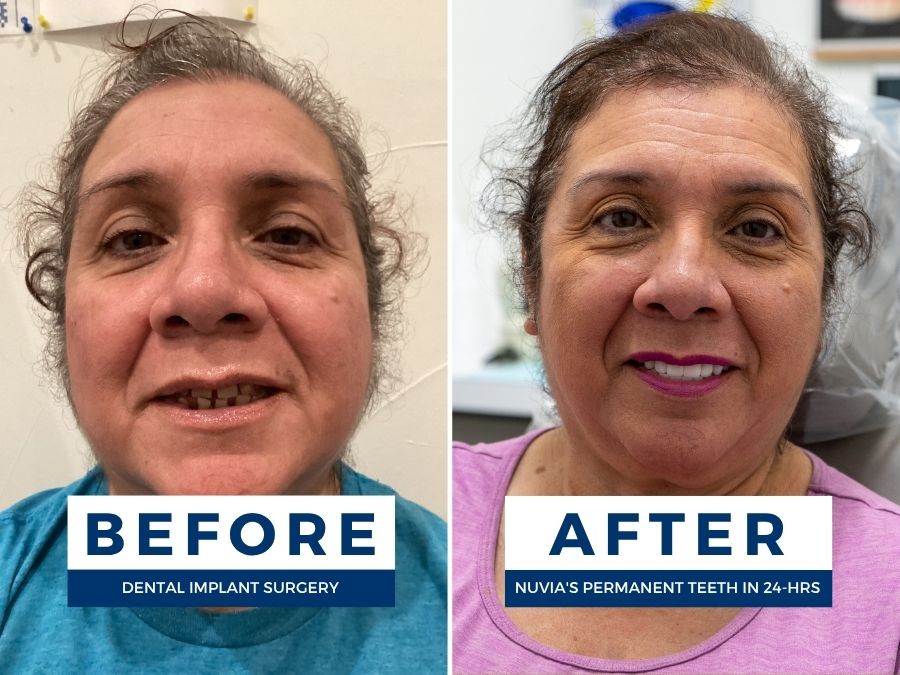 Woman smiling before and after having snap in dentures replaced by dental implants