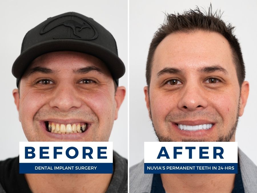 Man with failing teeth from genetics smiling before and after restoring his smile.