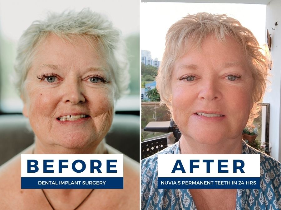 Woman smiling before and after having snap in dentures replaced by dental implants