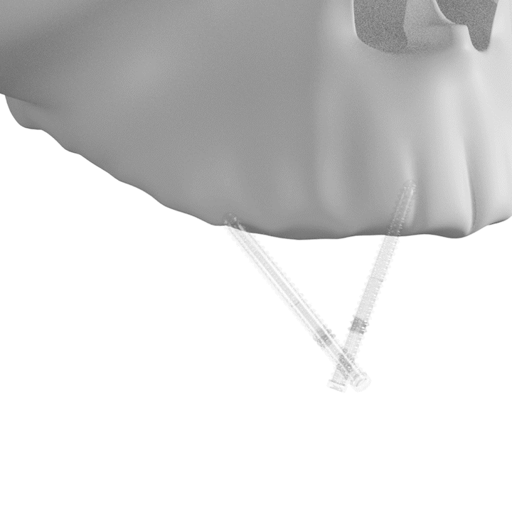 GIF of Zygomatic Implants Placed With Teeth Prosthesis Connected