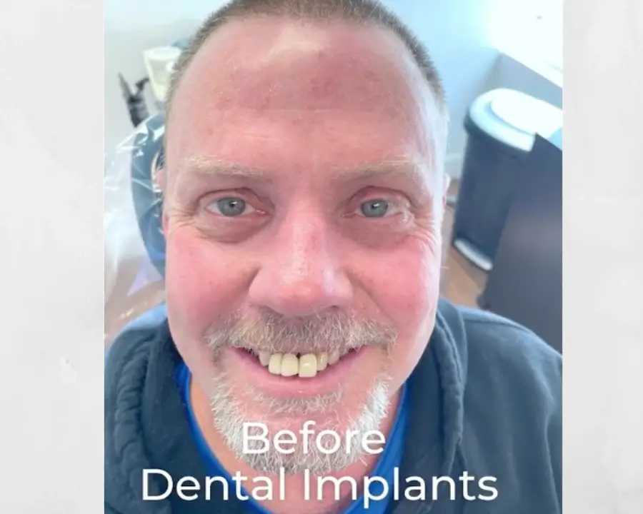 The Ultimate Guide to Full Mouth Dental Implants