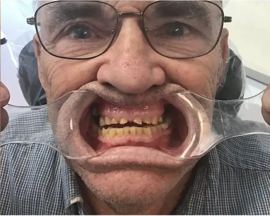 The Ultimate Guide to Full Mouth Dental Implants