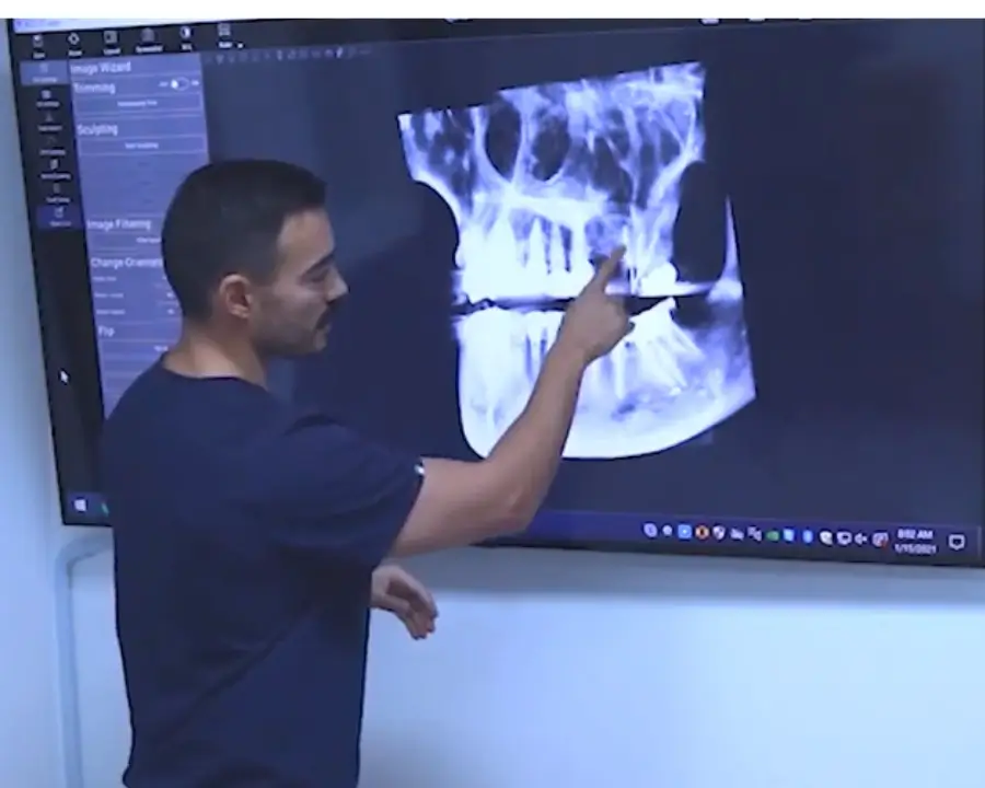 The Ultimate Guide to Full Mouth Dental Implants