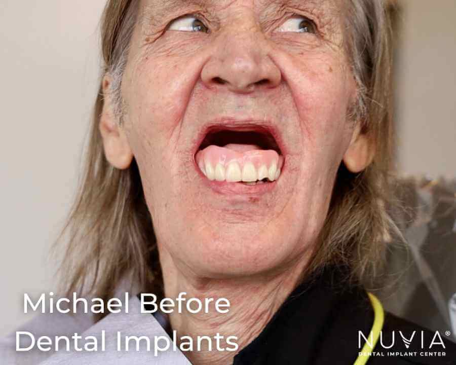 Michael in Dentures Before His Dental Implants