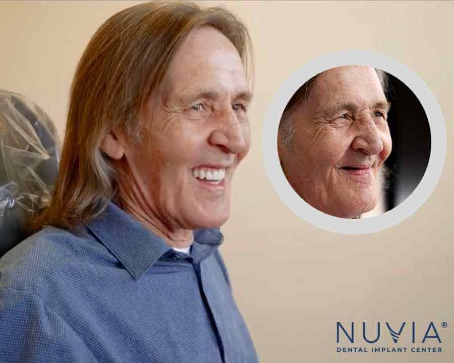 Face Shape With Dental Implants VS Dentures
