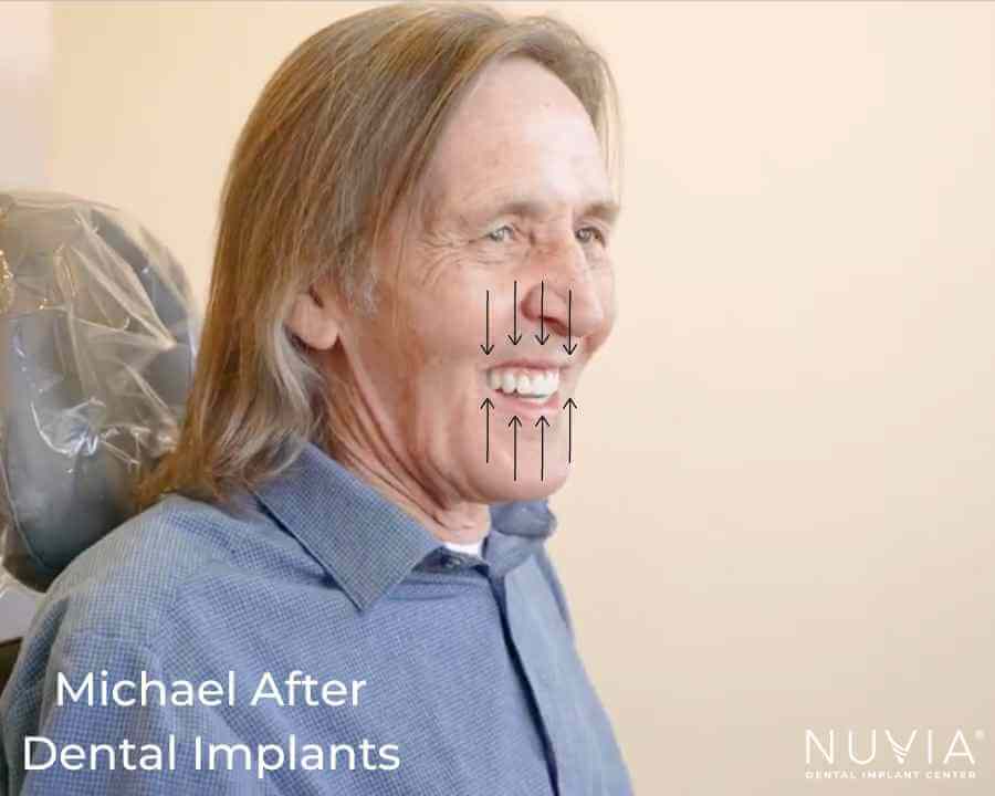 Michaels Face Share Restored with Dental Implants