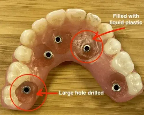 Conversion dentures that show the handmade holes used for the implants