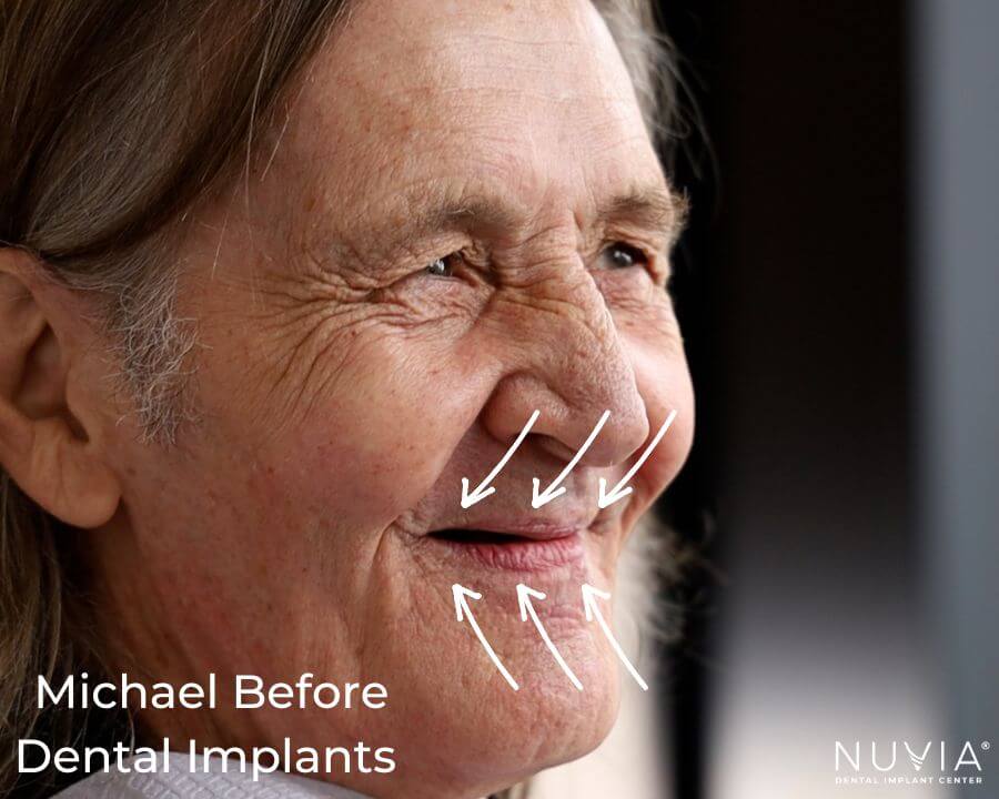 Facial Distortion of Dentures