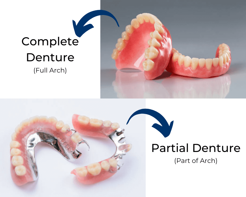 Complete Denture VS Partial Denture