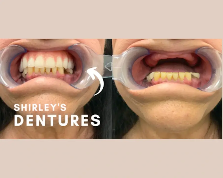The Ultimate Guide to Full Mouth Dental Implants