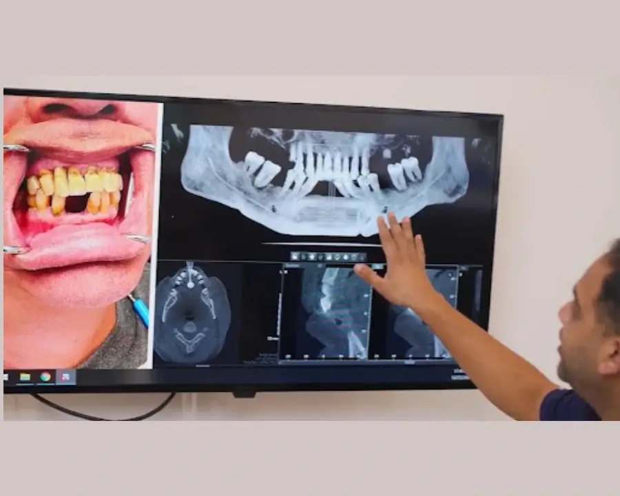 The Ultimate Guide to Full Mouth Dental Implants