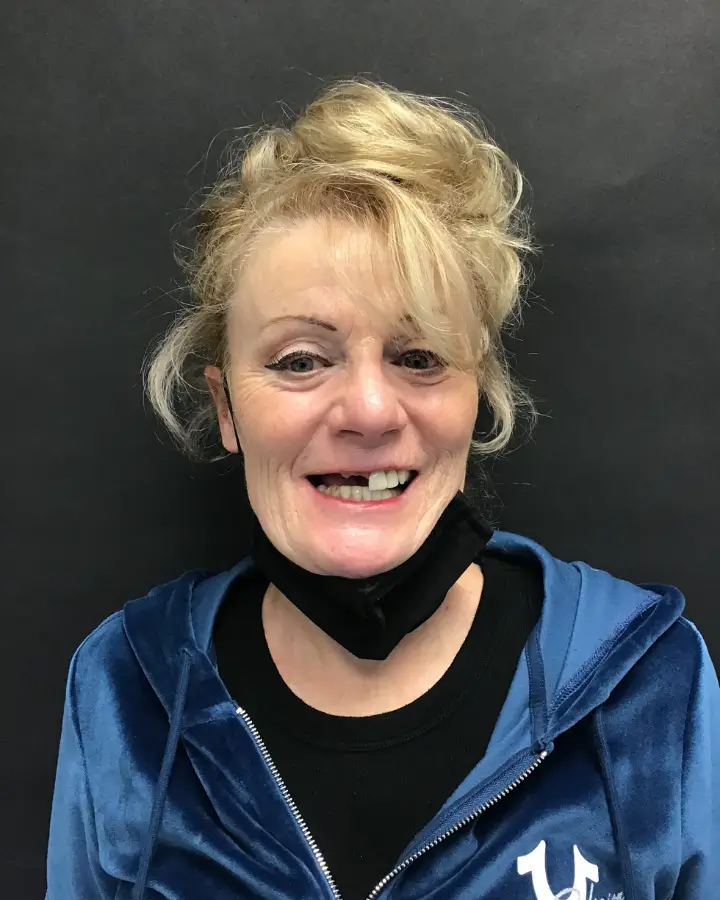 The Ultimate Guide to Full Mouth Dental Implants