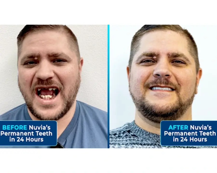 Billy smiling before and after dental implants
